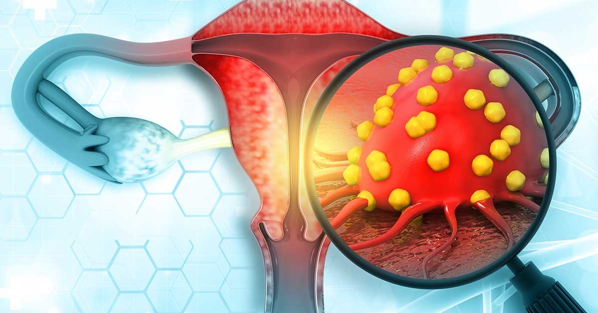 Is Your Lifestyle Secretly Saving You from Ovarian Cancer? Find Out Now!