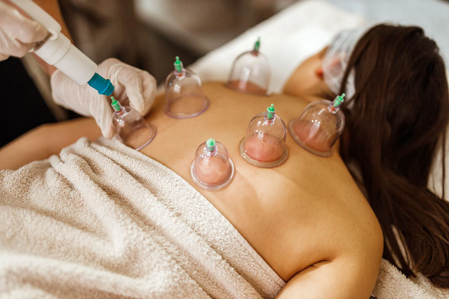 Ancient therapy or hype? The truth about cupping revealed!