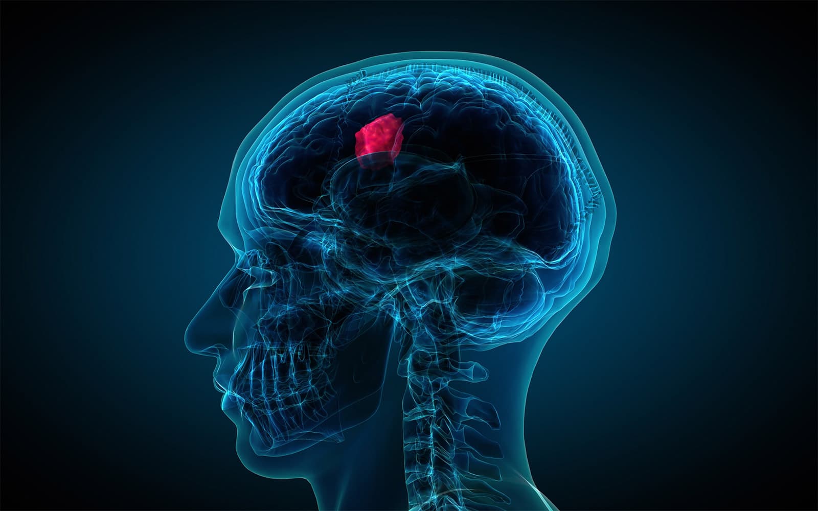 Air pollution may raise brain tumor risk, major 21-year study warns!
