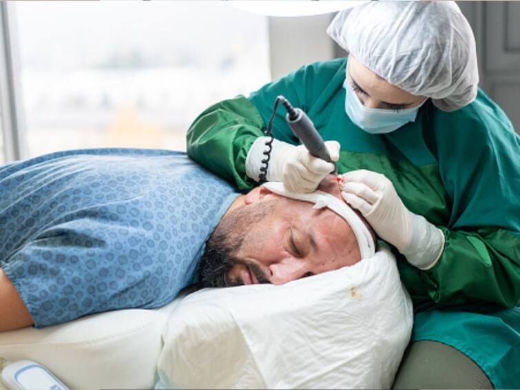 Hair transplant myths busted: What you really need to know!
