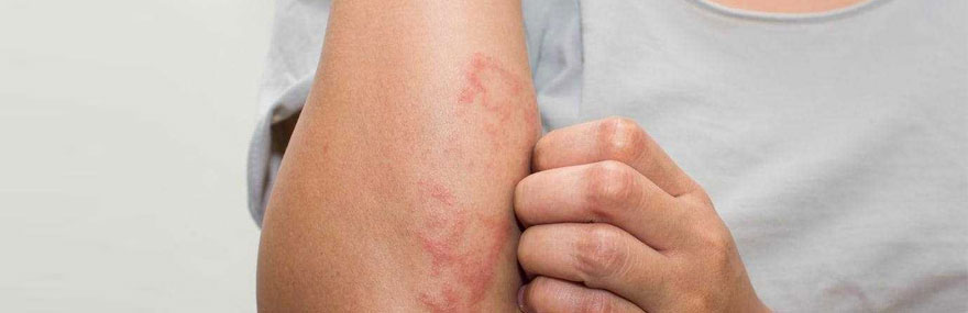 Monsoon brings leptospirosis threat, Here’s how to stay safe!
