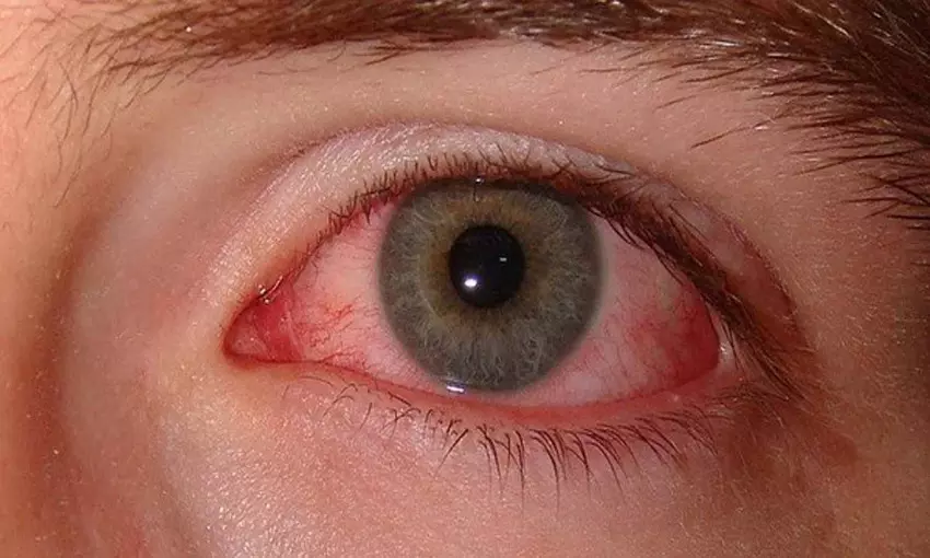 Eye Symptoms Indicating Kidney Trouble!