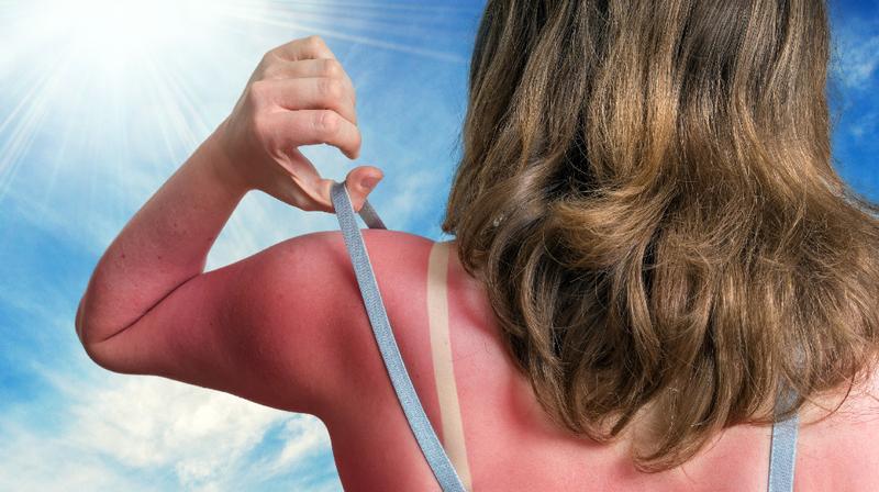 Sun poisoning can scar you! Save your skin now!