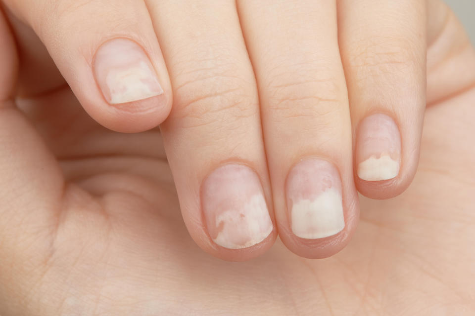 Lines on your nails? It could be a warning sign from your body!