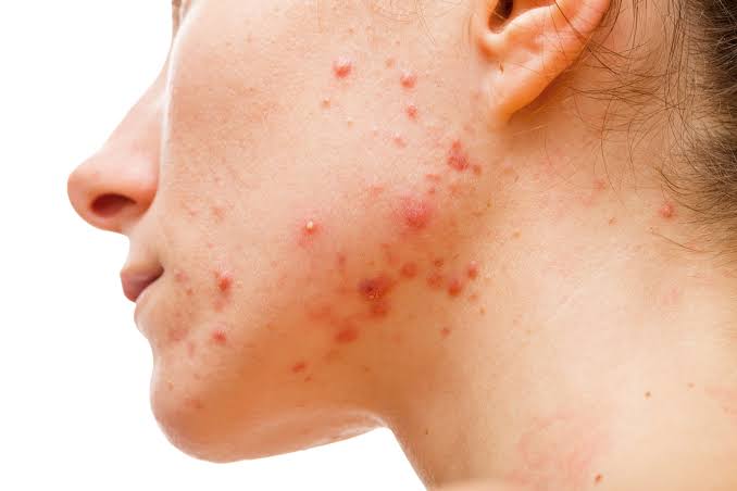 Treat your hormonal acne with these tips!