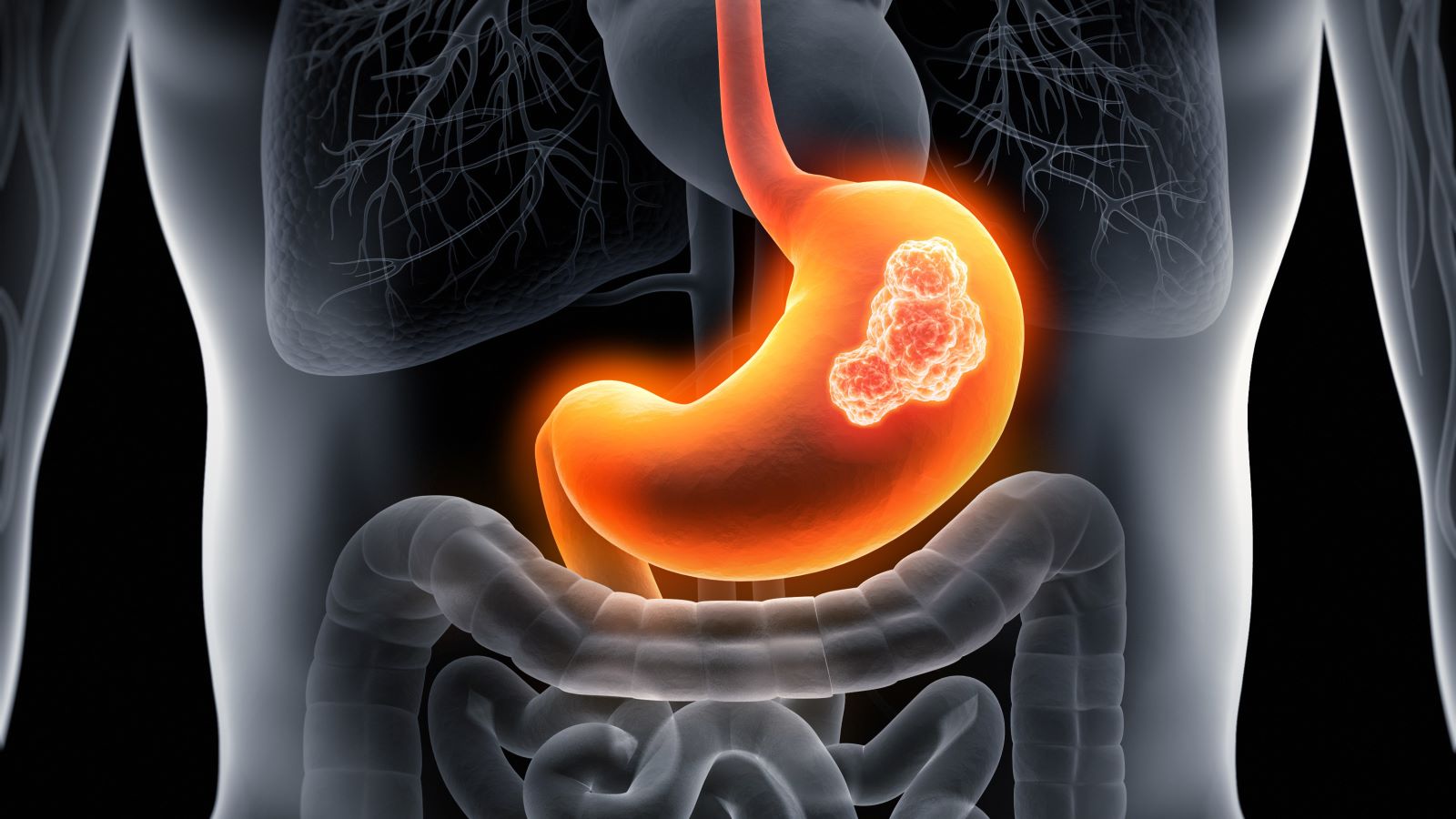 Gastric cancer risk for 15 Million born between 2008–2017, says study!